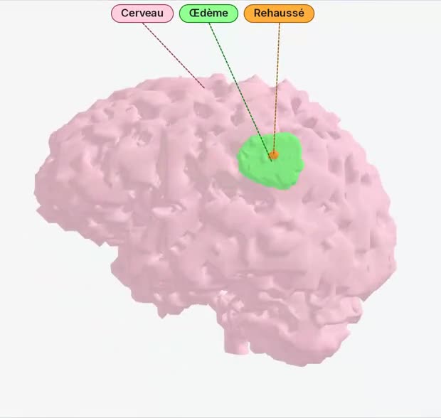 Cerveau segmenté en 3D : œdème en vert, rehaussement en orange