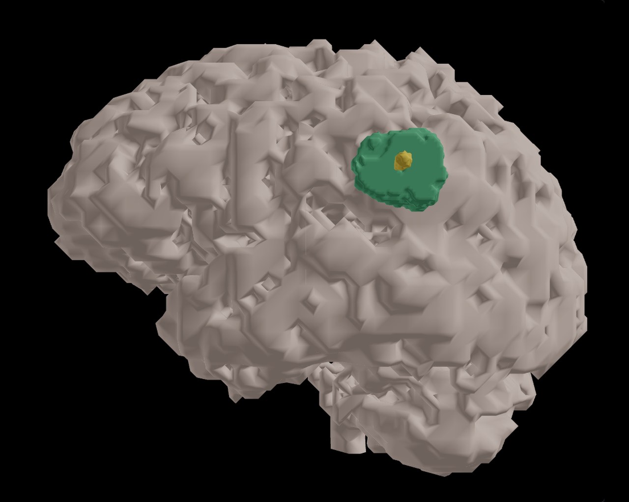 Cerveau 3D avec segmentation tumorale (BraTS 2023) — œdème vert, tumeur rehaussée jaune