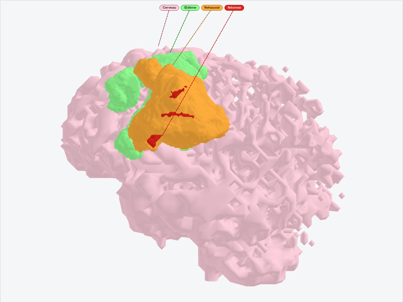 Cerveau segmenté en 3D après filtre des composantes : œdème en vert, rehaussement en orange, cœur en rouge