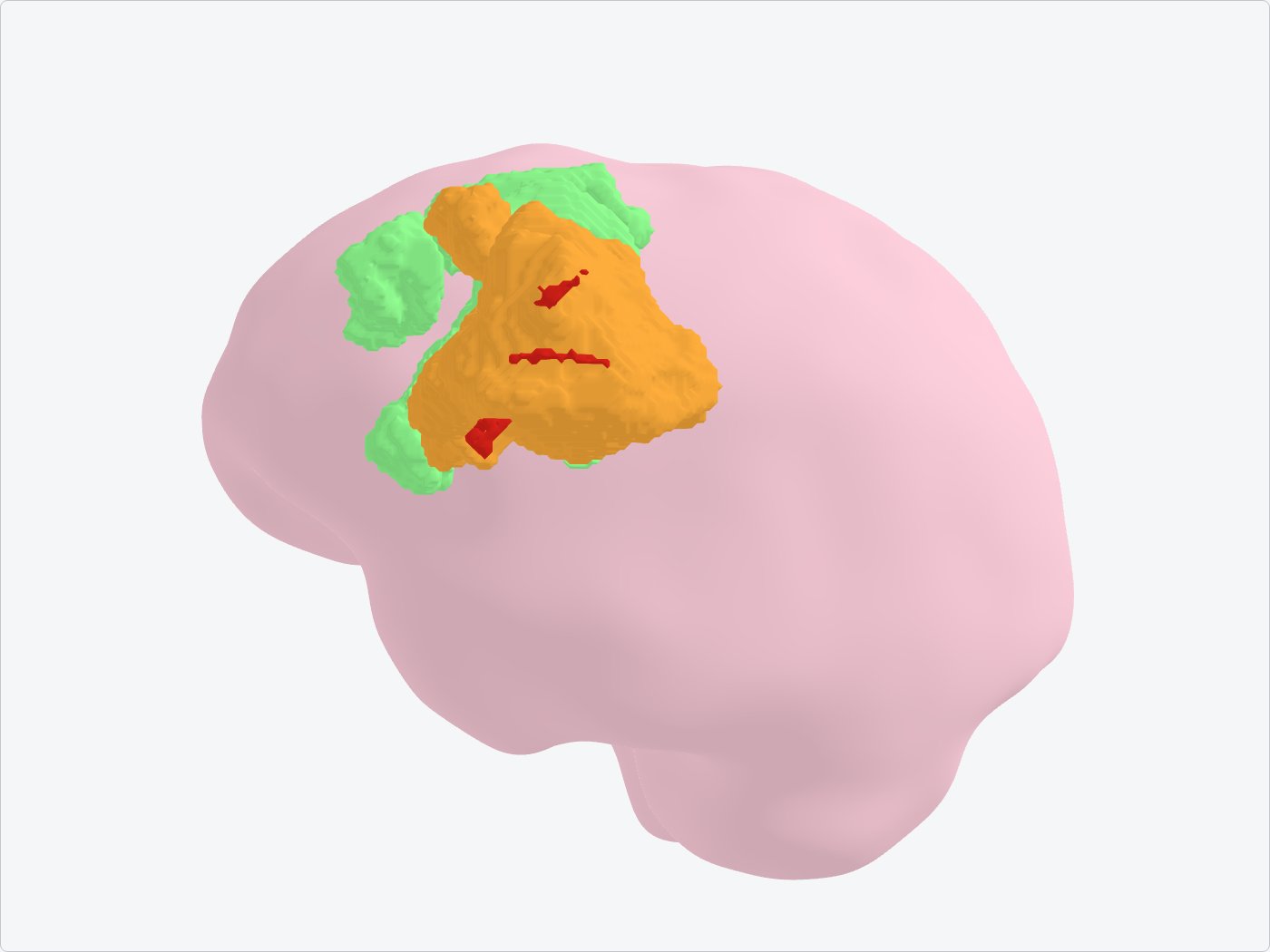 Cerveau segmenté en 3D après filtre des composantes : œdème en vert, rehaussement en orange, cœur en rouge