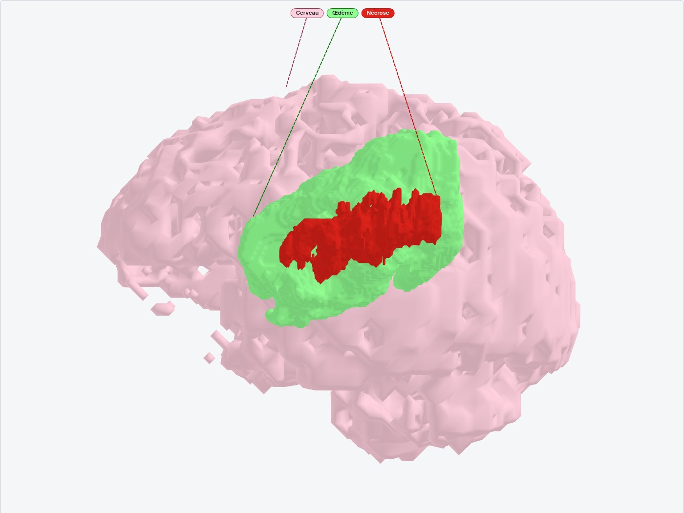 Cerveau segmenté en 3D d'un seul tenant (cas 01486, modèle Kervadec) : œdème en vert entourant la nécrose rouge
