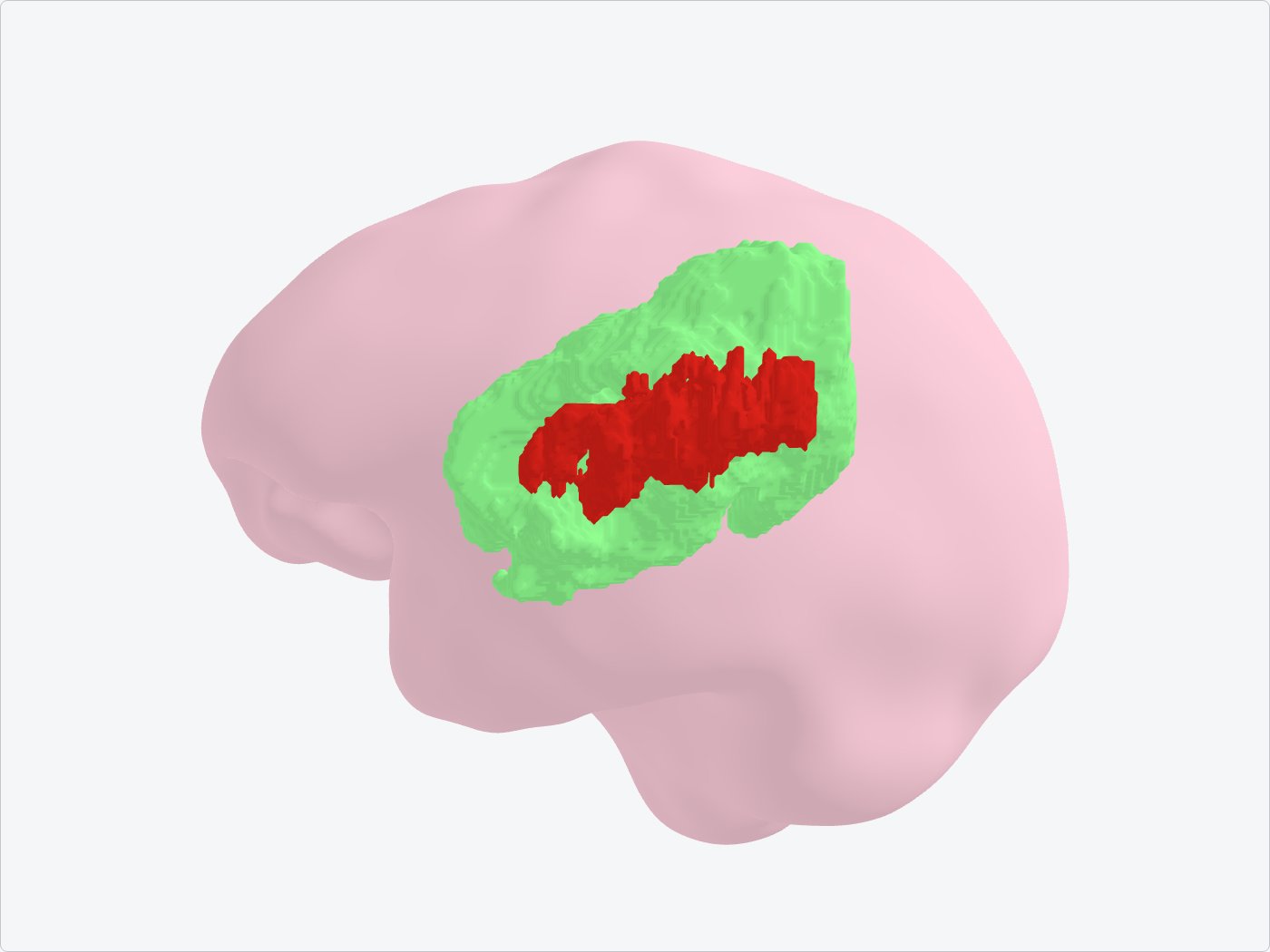 Cerveau segmenté en 3D d'un seul tenant (cas 01486, modèle Kervadec) : œdème en vert entourant la nécrose rouge
