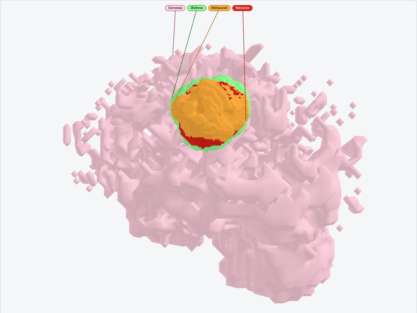 Cerveau segmenté en 3D par vote majoritaire (cas 00442) : rehaussement orange cerclé d'œdème vert, composantes éparses retirées