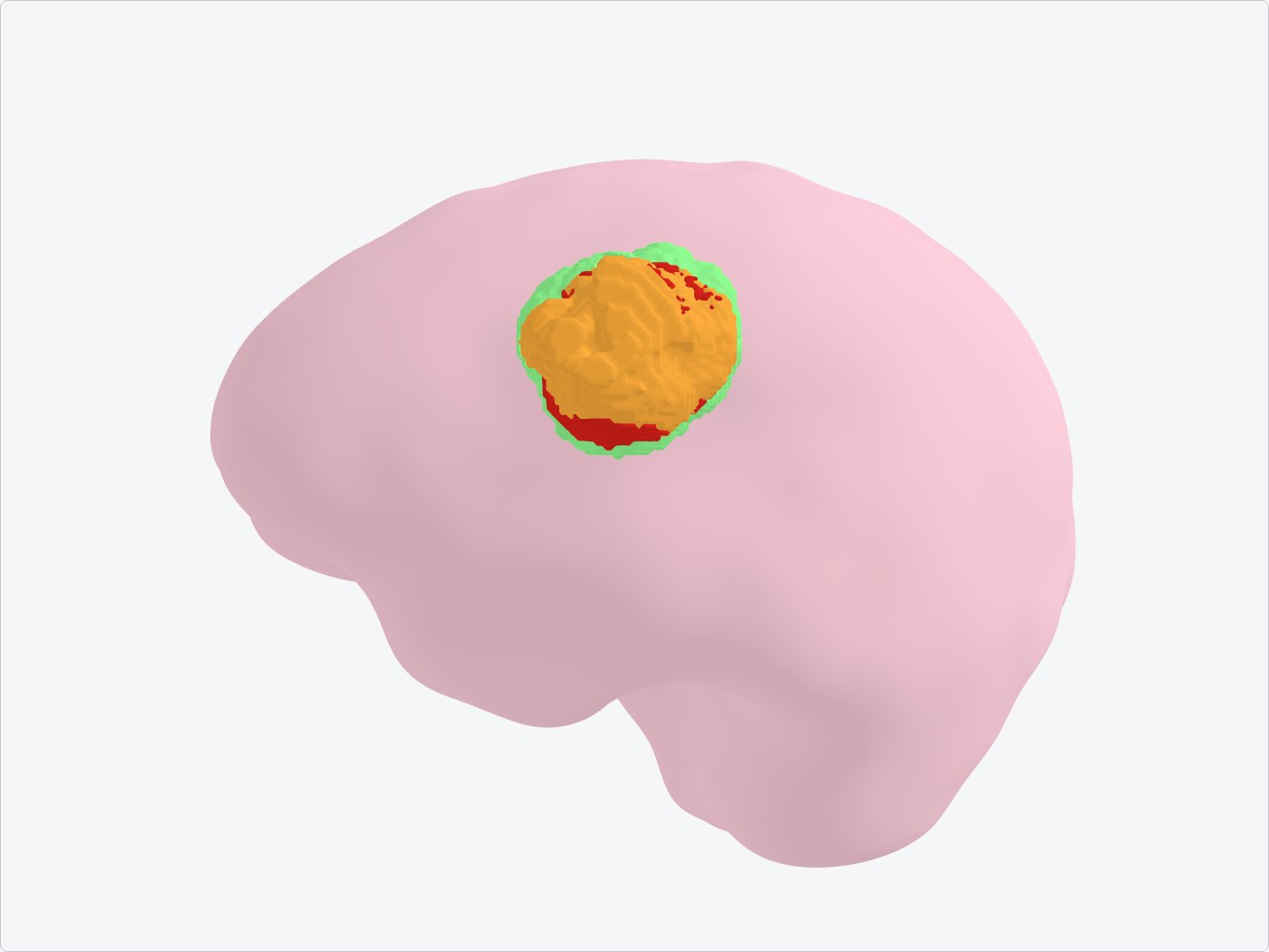 Cerveau segmenté en 3D par vote majoritaire (cas 00442) : rehaussement orange cerclé d'œdème vert, composantes éparses retirées